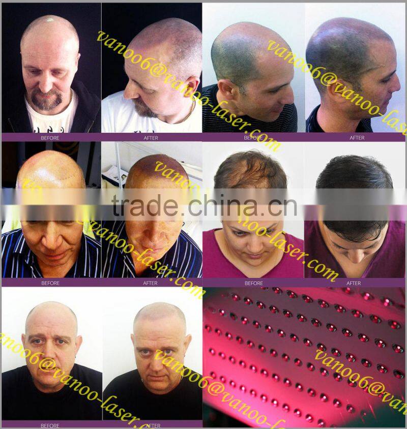 *2015 LLLT soft/cold diode laser permanent hair regrowth laser/hair stimulate beauty equipment