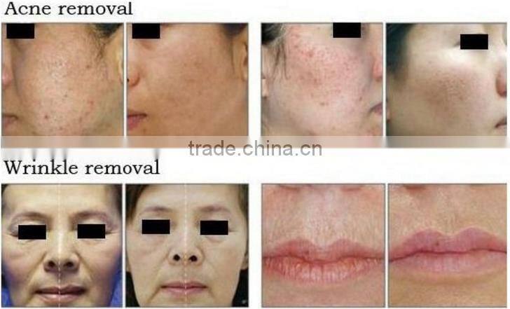 JMSHR Salon/Hospital Use 30W Korea Import Arm CO2 Fractional Laser RF Tube For Eyebrow Lid Removal