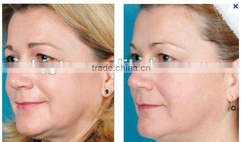 Derma roller/high quality titanium Needles Dermaroller