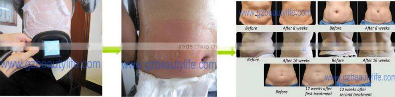 Hot Sale Cryolipolysis Machine/Fat Removal Freezing Fat Cryolipolysis
