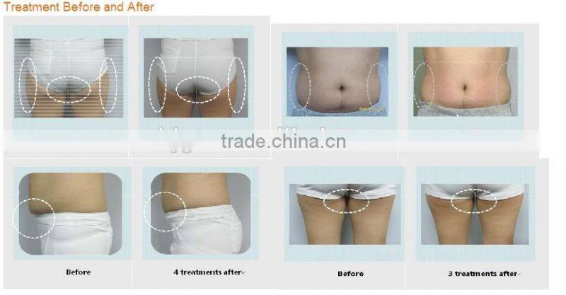 lipo suction cavitation vacuum slimming machine (CE approved)