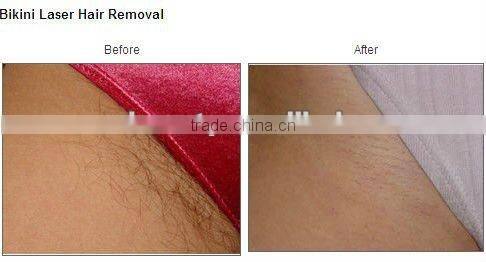 2012professional laser hair tattoo removal machine P003