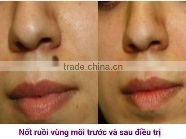 Alibaba Philipine nd yag laser tattoo removal machine/nd yag laser machine/q-switch nd:yag laser