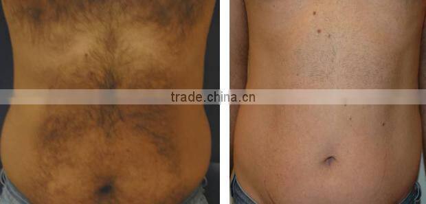 2016 High quality diode laser 808nm & 810nm hair removal machine with CE