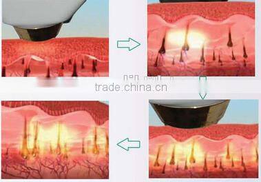 Double handles professional laser hair removal machinewith CE approved