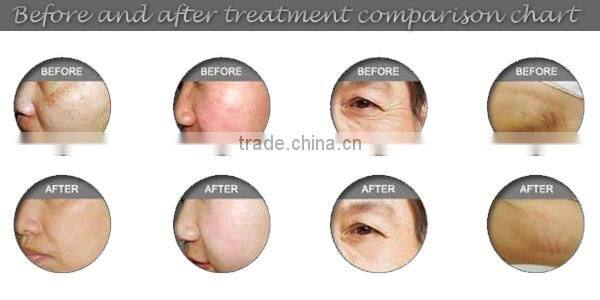 beauty ipl 2014 cheapest ipl machine price/multifunction laser beauty machine/shr ipl rf