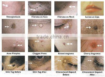 Spider vein cure beauty device laser equipment for spider veins
