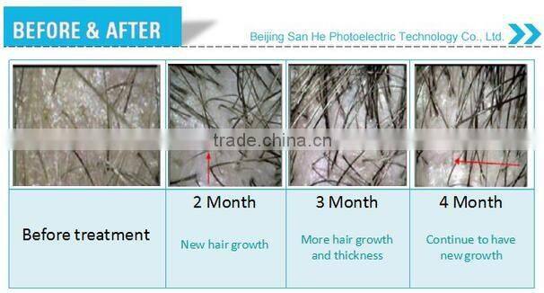 650nm/808nm Laser infrared laser hair growth stimulation machine