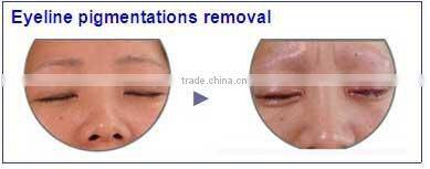 Nd. Yag laserlaser tattoo removal machine D001 China mianland manufacture