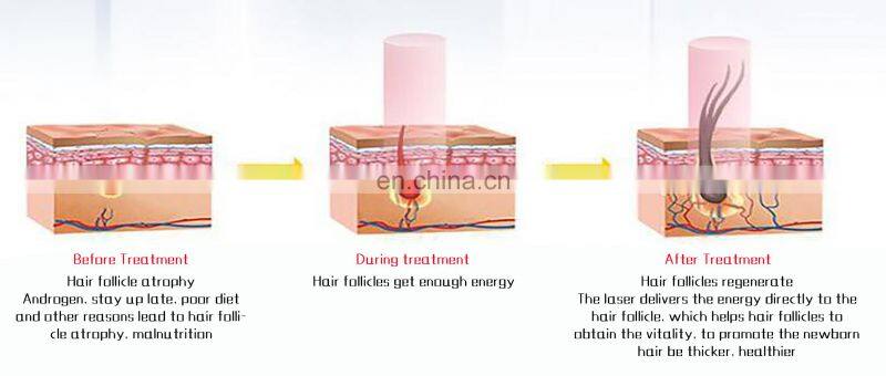 Low level laser hair growth helmets 650nm hair growth led light and Fda