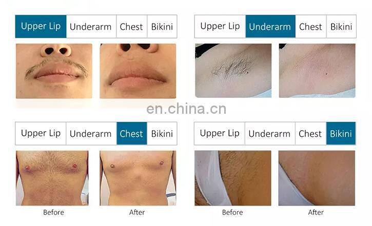 Professional 808nm 755nm 1064nm Wavelengths Diode Laser Hair Removal Machine For Women And Men