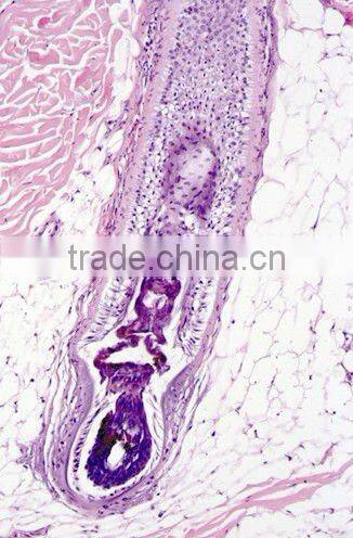 Diode Laser Hair Removal Machine