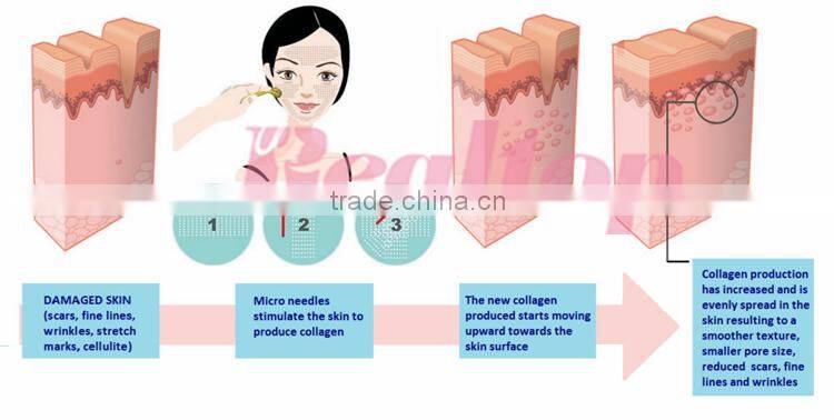 2016 Beauty equipment mezoroller! Dermaroller zgts rollers derma acne removal for skin face massage roller