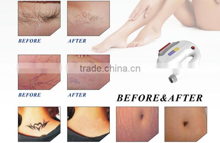 IPL Tattoo Removal Elight RF Machine Multifunction Machine