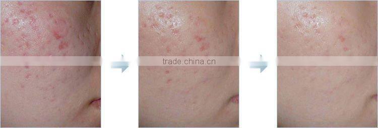 Derma Roller With Changeable Head L001 CE Approval