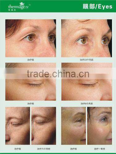 rf beauty machine rf equipment rf home use face lift devices AYJ-T28 CE