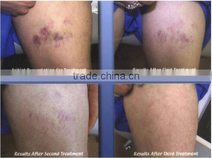 permanent remove vascular machine by 980nm diode laser