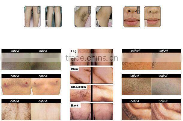 808nm diode laser hair removal beauty salon equipment machine / laser hair remove 808nm diode laser