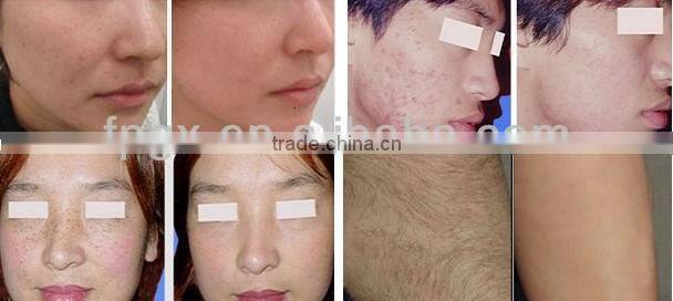 Customized most popular ipl rf