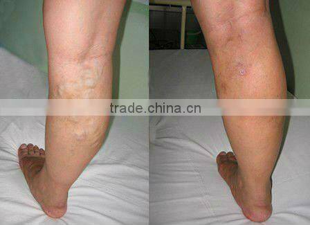 long pulse nd yag laser with skin contact cooling system P-C01