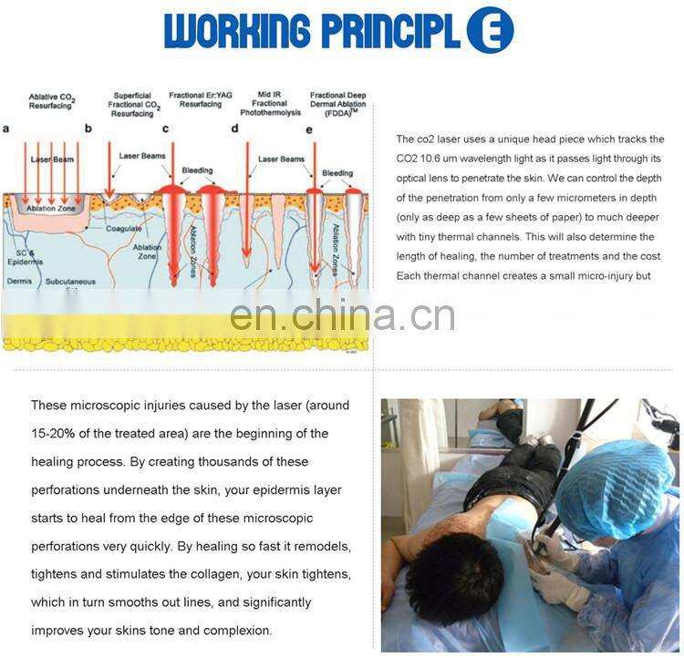 Technology advanced co2 fractional laser skin resurfacing fractional co2 laser machine
