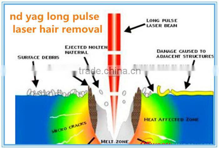 global hot selling products 1064nm long pulse nd yag laser photoepilation treatment