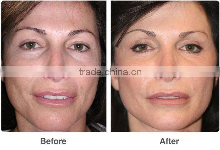 best acne treatment products LED photodynamic therapy skin care