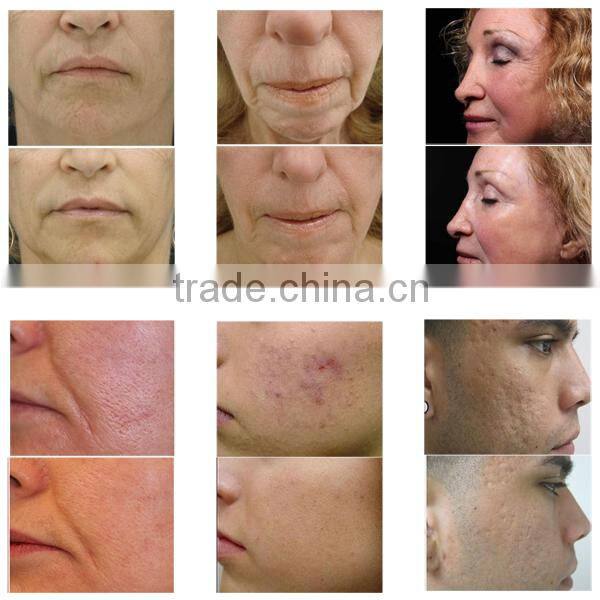 Fractional RF Microneedle Beauty Equipment for Skin Lifting Skin Care