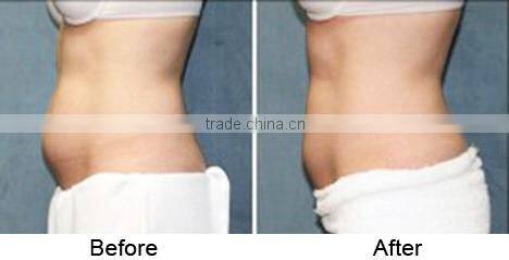 New coming Lipo Ice fat cryolypolysis machine 3d lipo salon