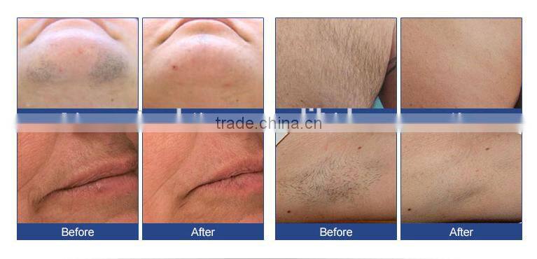 Pain Free Diode Laser 808nm Ice Cooling 808nm In Motion Laser Hair Removal
