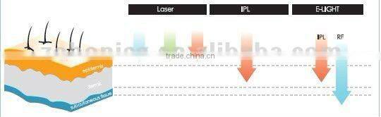 E5B new style ipl rf e-light 2 handles Super vertical hair removal