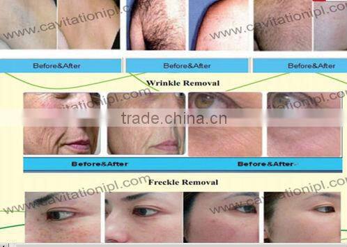 Hot!! CE approved professional hair removal cream with IPL system
