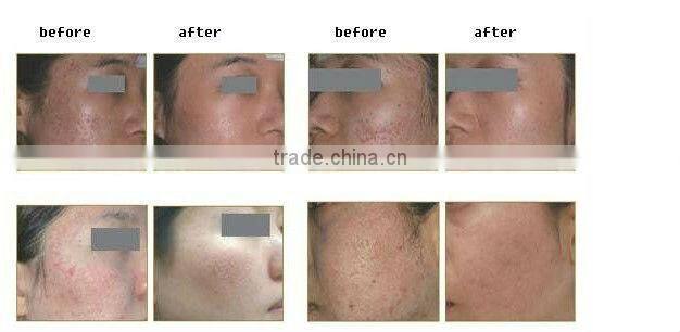 Agency wanted for scar removal rf CO2 fractional laser(60w)