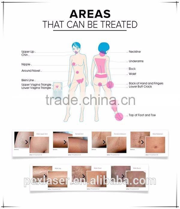 2016 808 nm laser diode portable hair removal