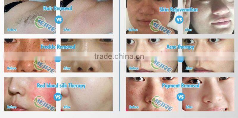 New design ipl shr opt laser permanent ipl laser removal