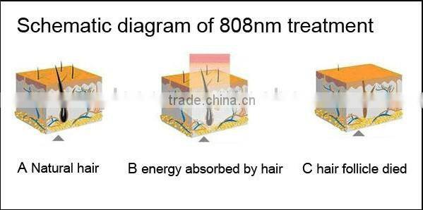 lightsheer diode laser hair removal medical equipment