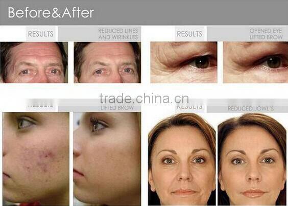 Ultrasonic beauty machine with high frequency vacuum spray OL-3001A beauty massage