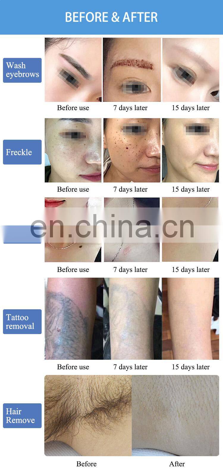 Vertical 808 diode laser therapy picosecond tattoo pigment removal hair removal machine