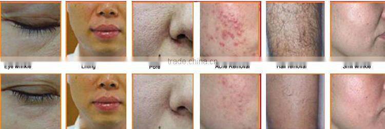 High quality most popular products for salon SHR+E-light(IPL+RF )Machine with 2 handles