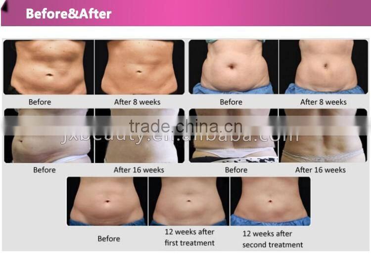 cheap portable ultrasound cavitation equipment slimming products malaysia