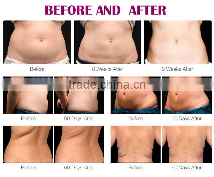 5 in 1 fast cavitation rf machine korea