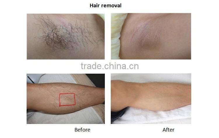 Professional 3 in 1 facial machines for home use with elight(CE, RoHs, PSE approved) skin rejuvenation device with shot counter