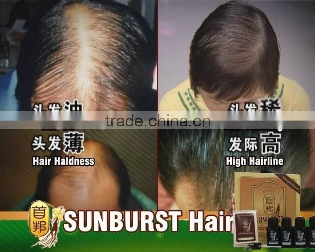 100% genuine Original real result New sunburst hair growth 50ml*6 bottles fast hair growth 100% genuine