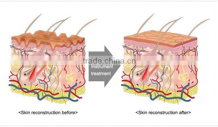 osano ipl laser hair removal skin tighten thighs rejuvenation machine