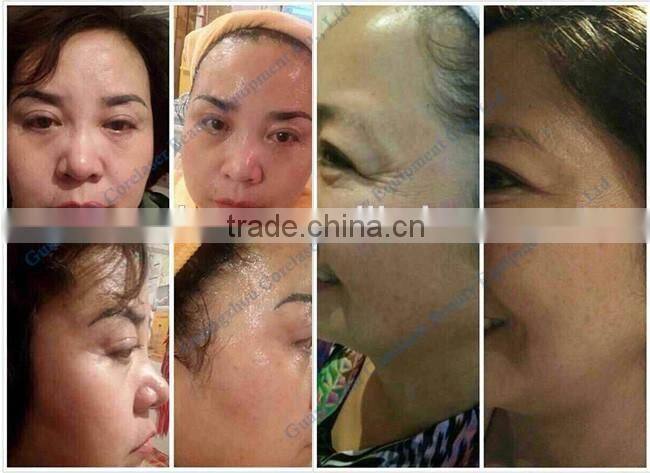HIFU Machine High Intensity Focused Ultrasound Best Face Lift and Wrinkle Removal Machine