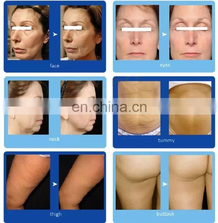 2 in 1 Vacuum cavitation system fat cutting Ultrasound RF weight loss machine