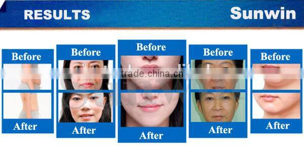 hifu for skin tightining beauty machine SW-131B