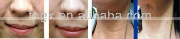 Super quality professional freezing vacuum beauty equipment