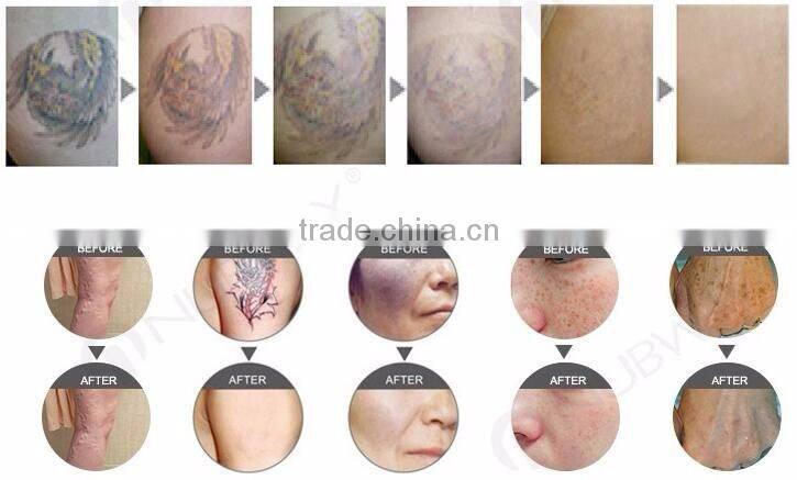 1064 nm / 532nm pigments tattoo removal varicose veins laser treatment q-switch nd yag laser