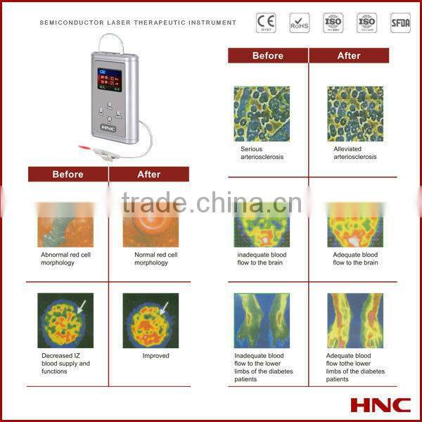 650nm red laser irradiation safe treatment laser therapy device 650nm for allergic rhinitis, chronic rhinitis, sinusitis